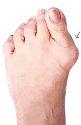 Bunion Revision Surgery, Failed Bunion Surgery, University Foot and Ankle Institute