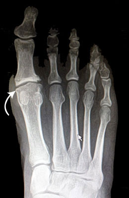 Hallux Limitus Big Toe Arthritis Pre Surgery, University Foot and Anke Insittute