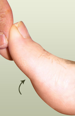 Hallux Limitus Before Surgery - University Foot and Ankle Institute