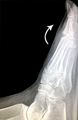 Lateral Fusion Before Surgery - University Foot and Ankle Institute