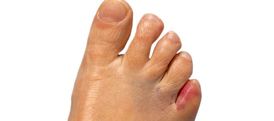 There’s nothing you can do for a broken toe...Or is there?