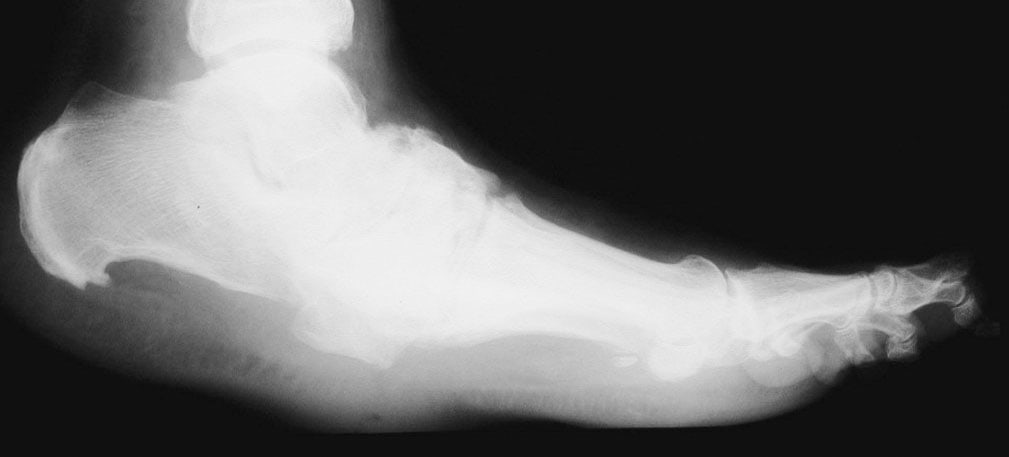 Everything You Need to Know About Charcot Foot... But Were Afraid to Ask