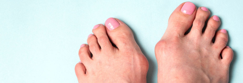 What’s the Best Treatment for Bunions? Seeing a Bunion Specialist for Starters. Here’s Why