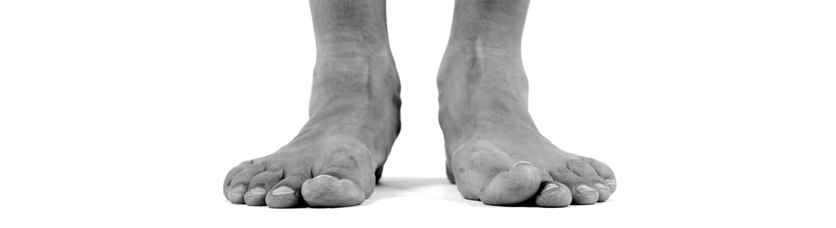 flat feet treatments
