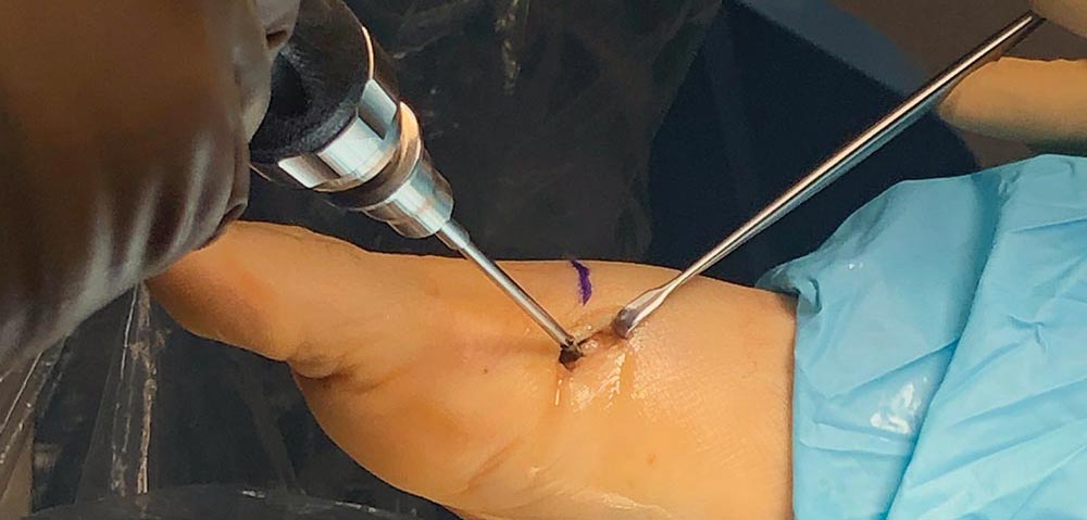 Emerging Advances in Minimally Invasive Bunion Surgery