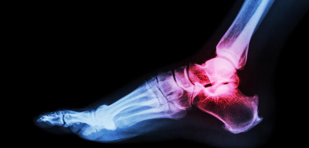 New Treatment for Ankle Arthritis: Advanced Cartilage Replacement