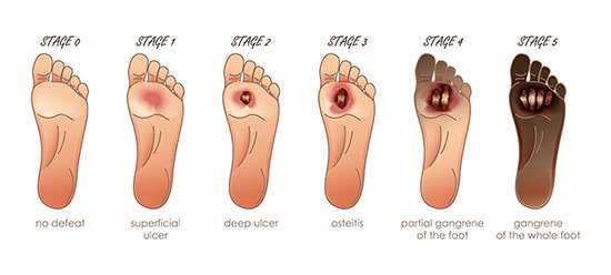 Diabetic Foot Ulcer: treatment and prevention