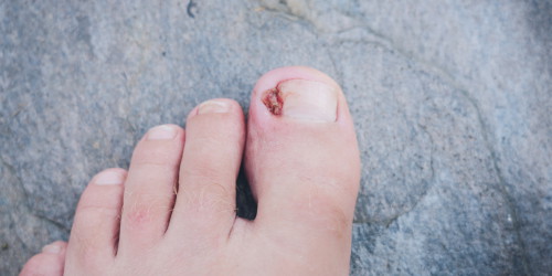 Is that a Staph Infection? Dealing with an Infected Ingrown Toenail
