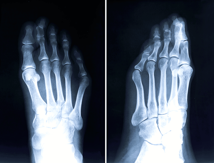 Understanding Tailor's Bunions: Causes, Symptoms, and Solutions