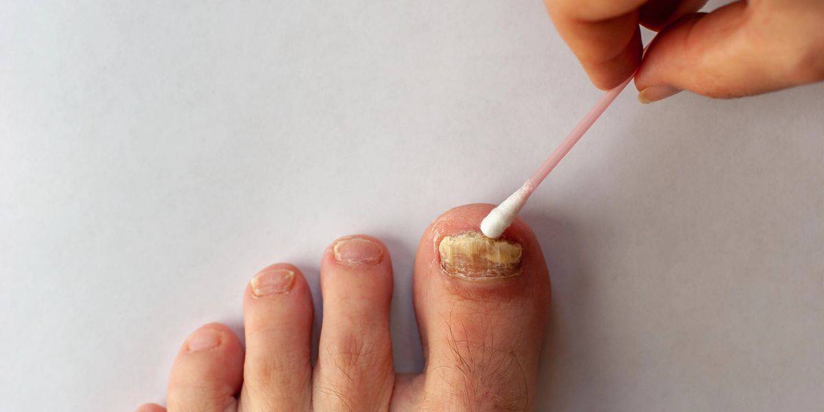 What To Do When Your Toenail Is Falling Off