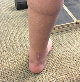 PARS Achilles Rupture Repair Scar Results