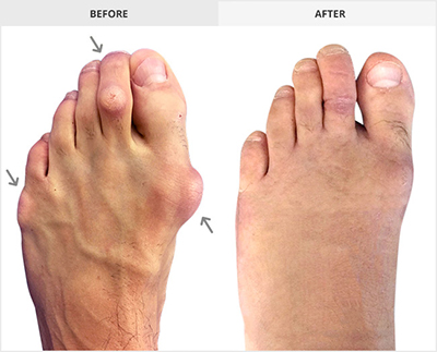 Lapidus Bunion Surgery, Forever Bunionectomy, Best Bunion Surgeon Los Angeles