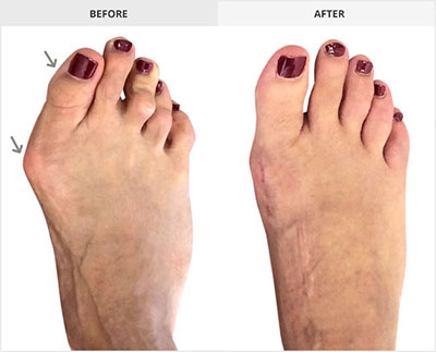 Osteotomy Bunionectomy, Best Bunion Surgeons Los Angeles