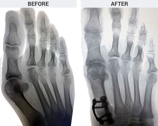 Lapiplasty Before and after picture