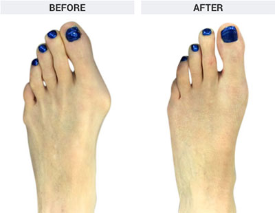 Minvasive Bunion Surgery, Santa Monica Bunion Surgeon, Best Bunions Surgery