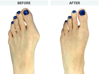 Minvasive Bunion Surgery, Santa Monica Bunion Surgeon, Best Bunions Surgery