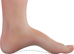 Cavus Foot, high arches