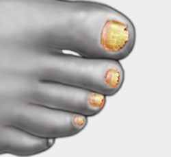 How to Treat Toenail Fungus