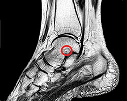 Talar Dome Cartilage Damage