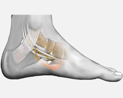 Tarsal Tunnel Syndrome Treatments