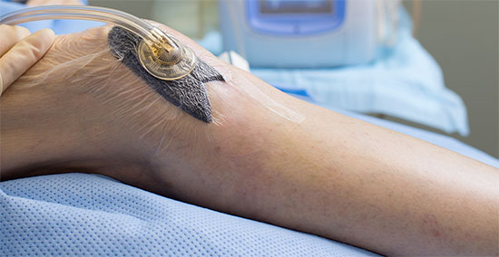 Wound VAC treatment