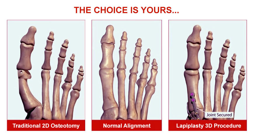 Lapiplasty Bunion Surgery Before and After Picture